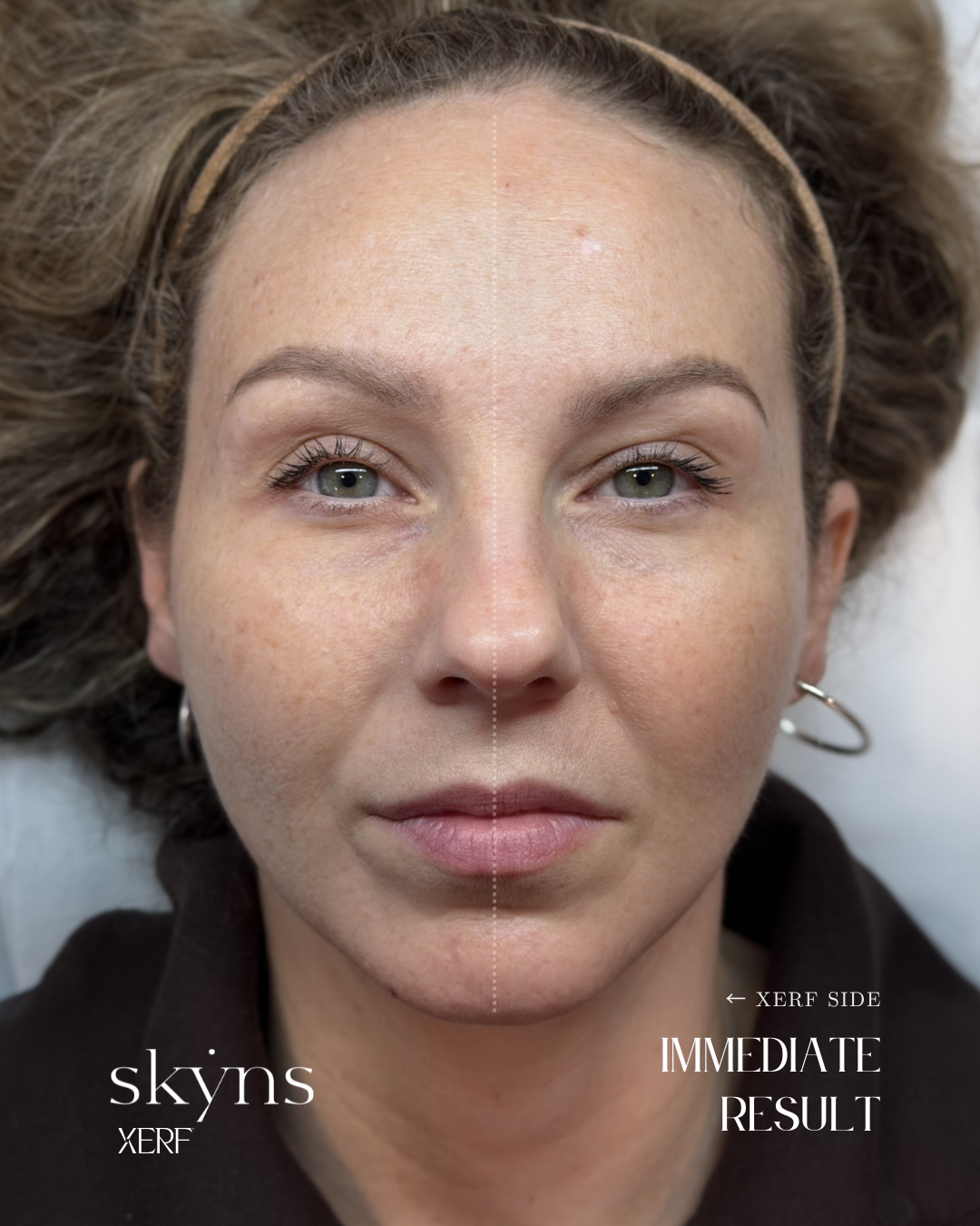XERF treatment highlighting facial support on the treated side.