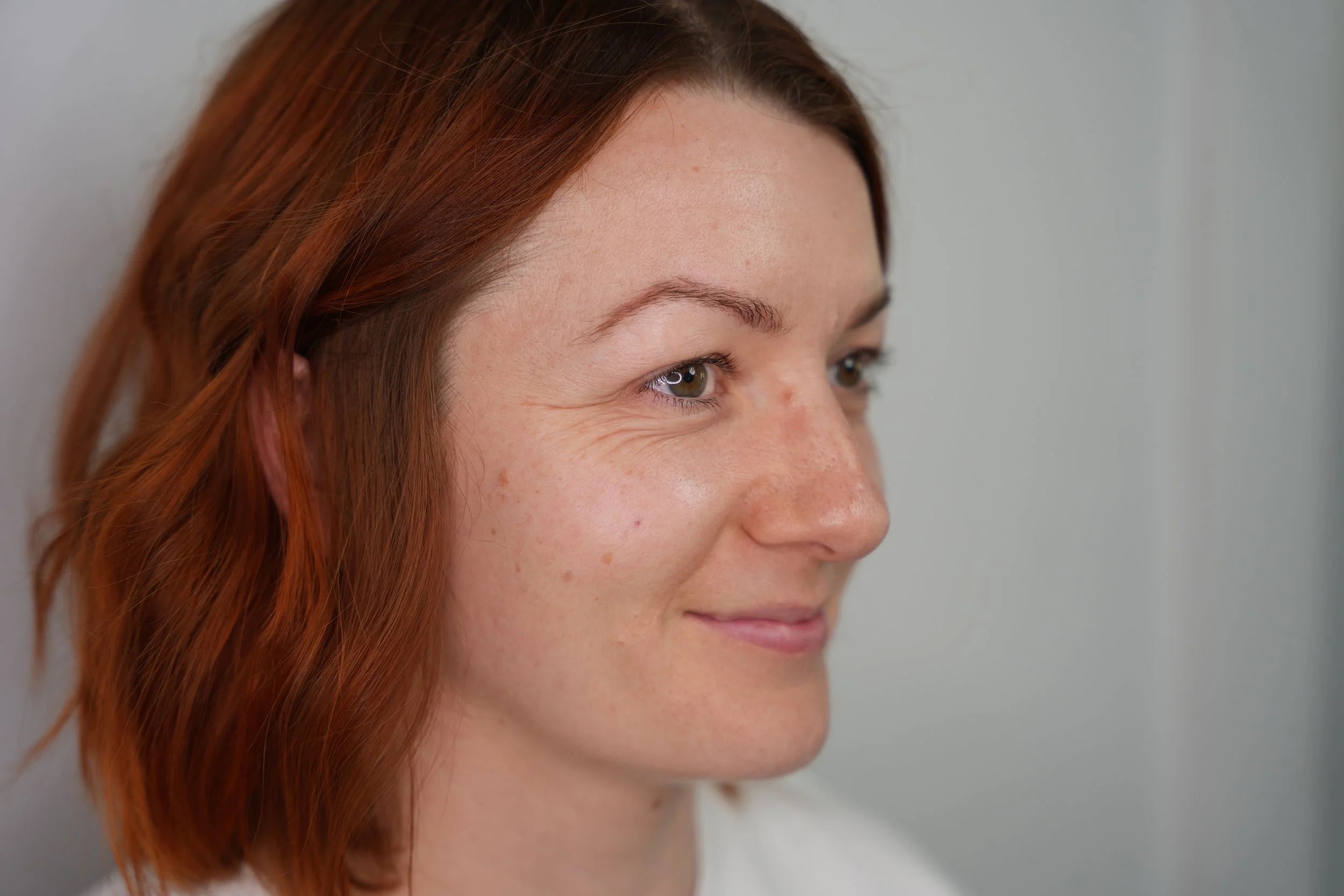 1.Skyns Skin Rejuvenation Treatment Calgary.JPG