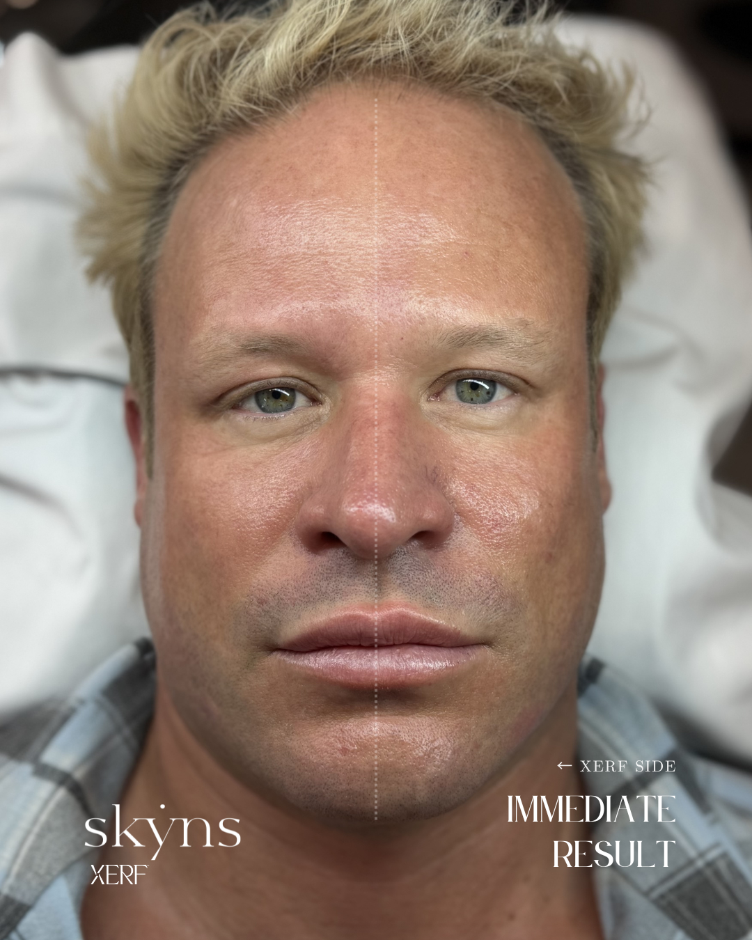 Immediate treatment response following XERF structural skin tightening.