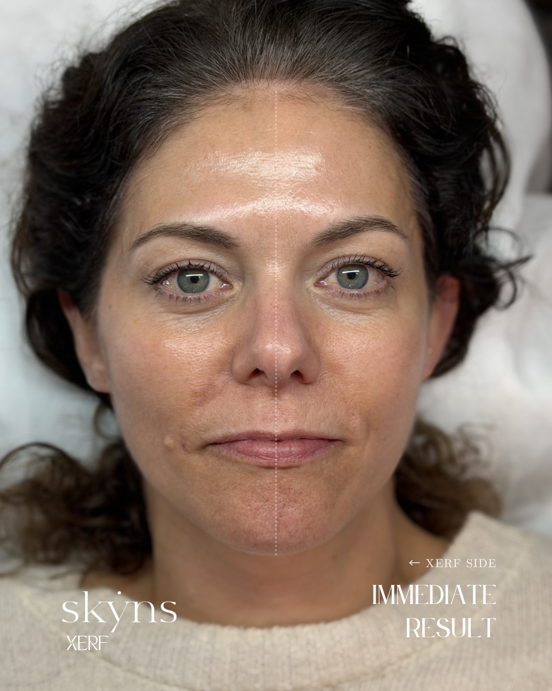 XERF treatment illustrating the treated side immediately following treatment.