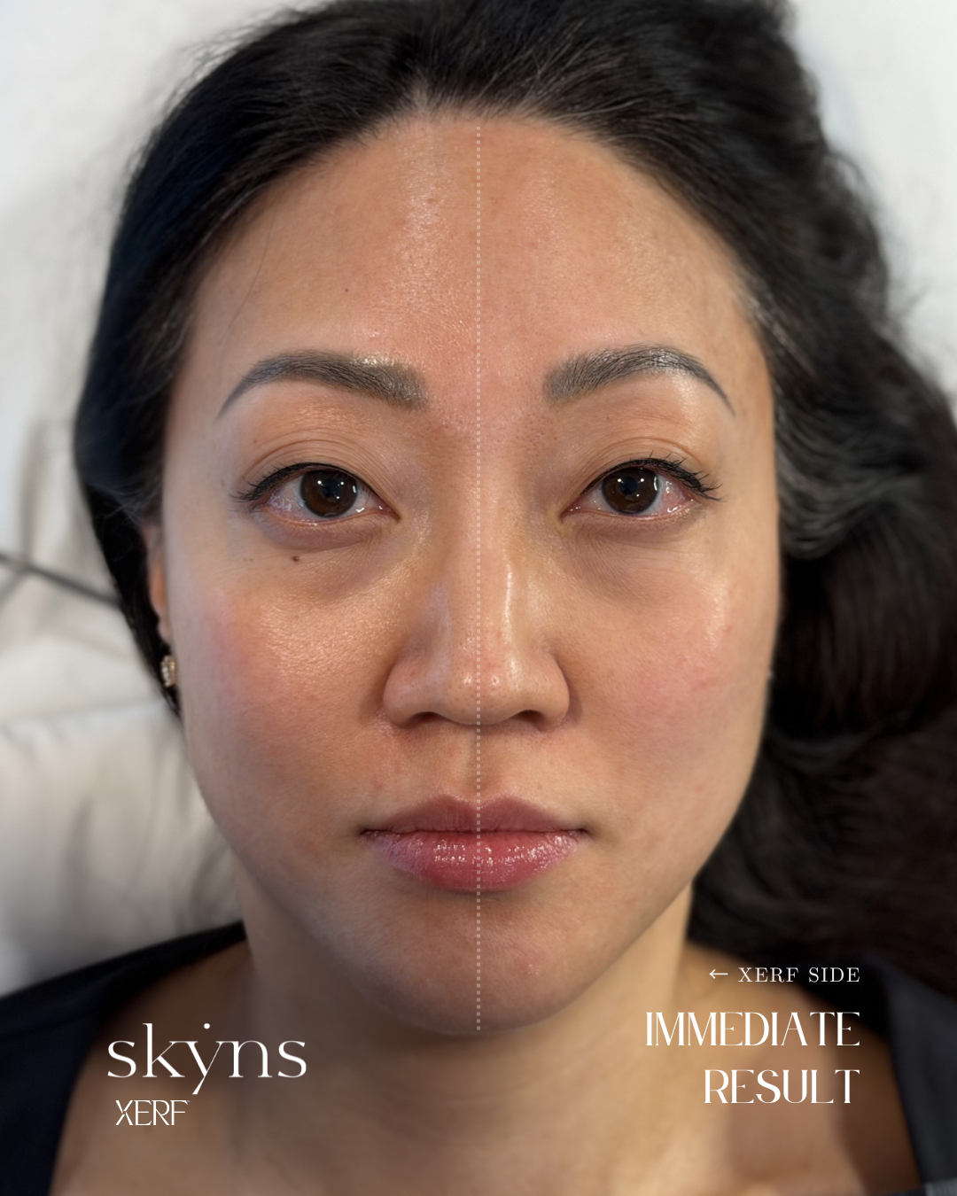 XERF treatment focused on supporting facial structure and skin quality.