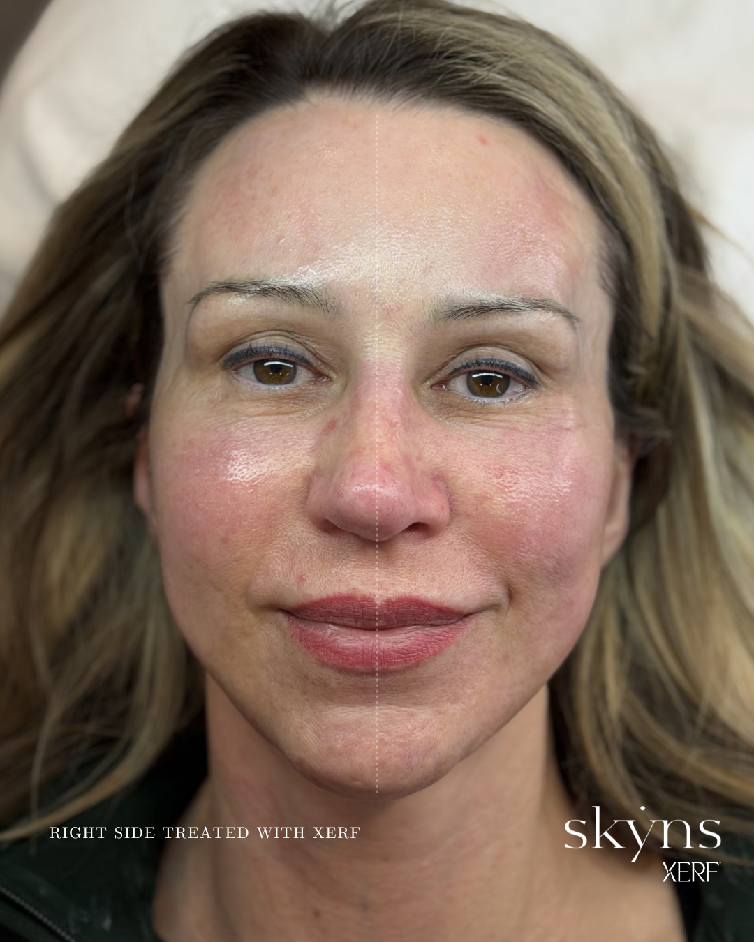 xerf-calgary-before-after-half-face-4.png