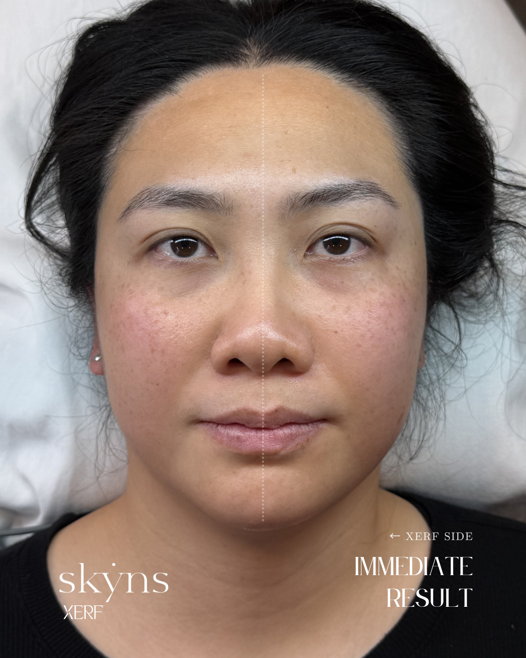 XERF treatment highlighting structural support and immediate tissue response.