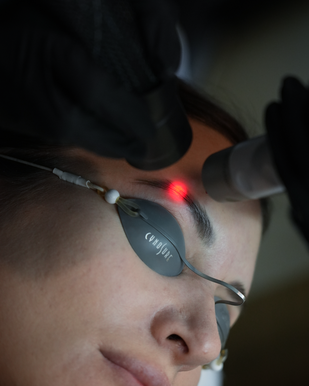 PicoSure Pro cosmetic tattoo removal treatment for eyebrow tattoo correction at SKYNS Calgary
