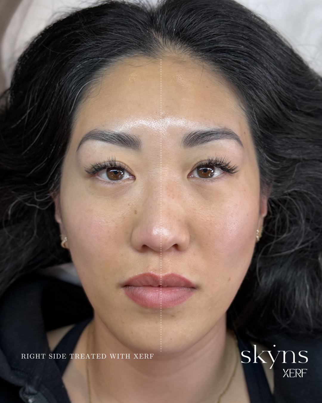 xerf-calgary-before-after-half-face-26.png