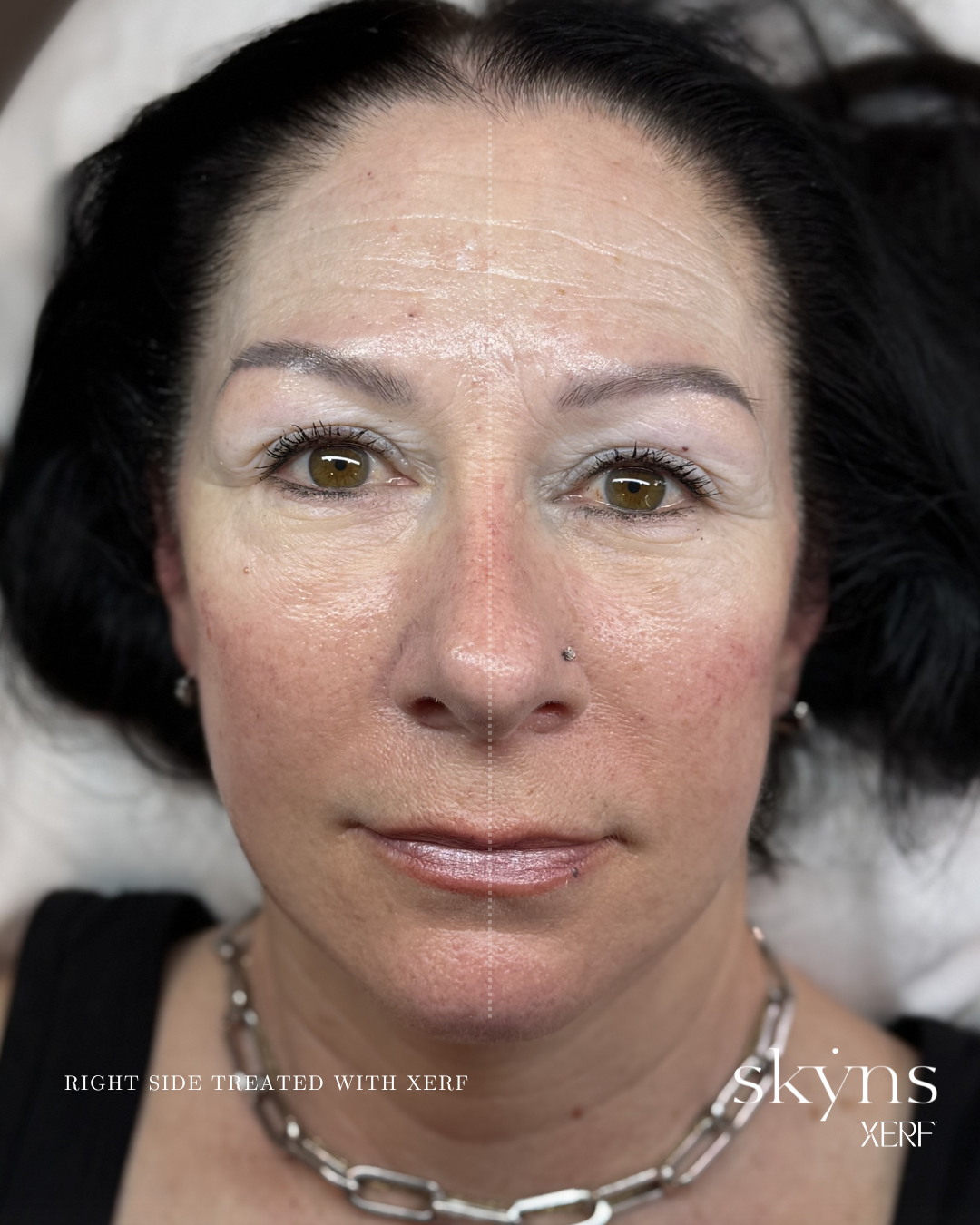 xerf-calgary-before-after-half-face-8.png