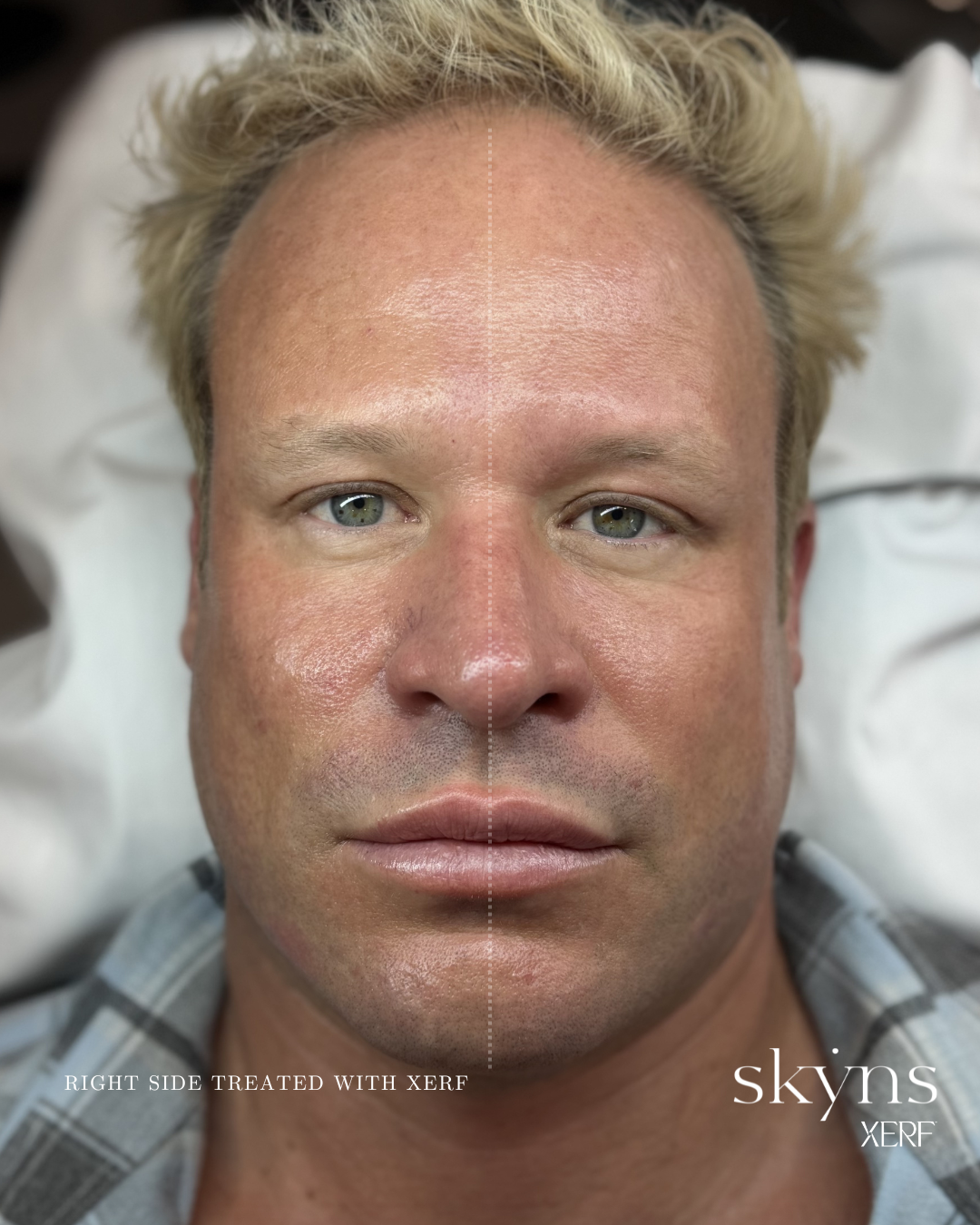 xerf-calgary-before-after-half-face-6.png