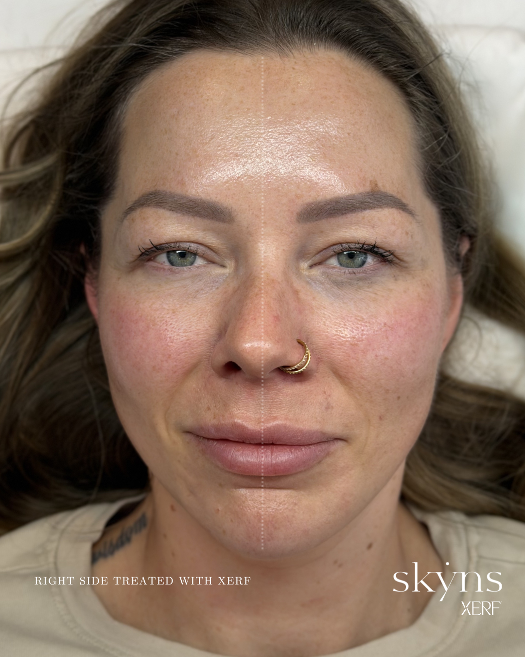 xerf-calgary-before-after-half-face-15.png