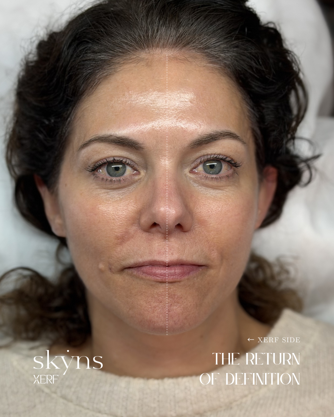 XERF structural skin tightening results