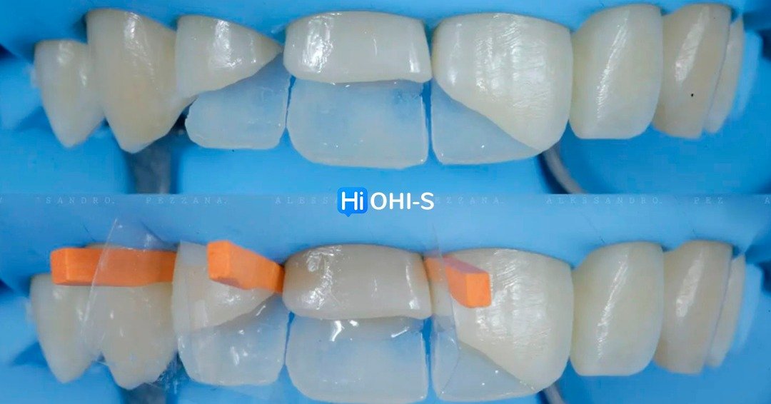 International schools working with composite restorations 5.jpg