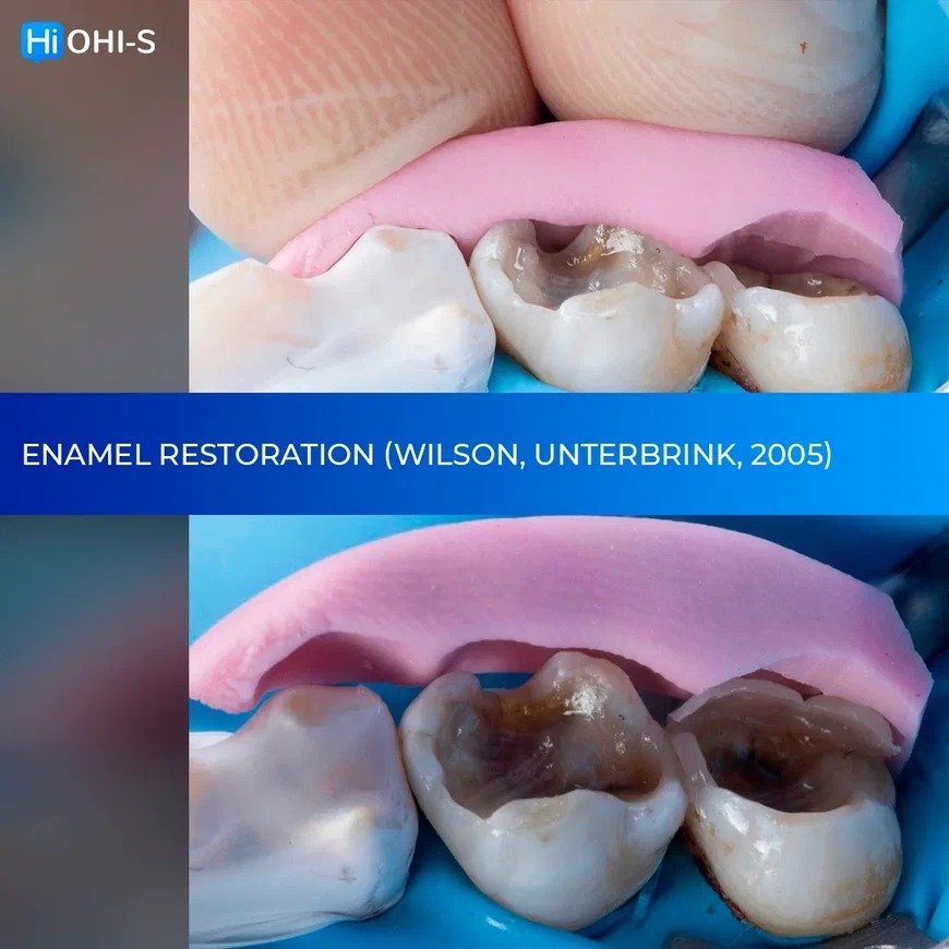 The Biomimetic concept composite restoration protocols 3.jpg