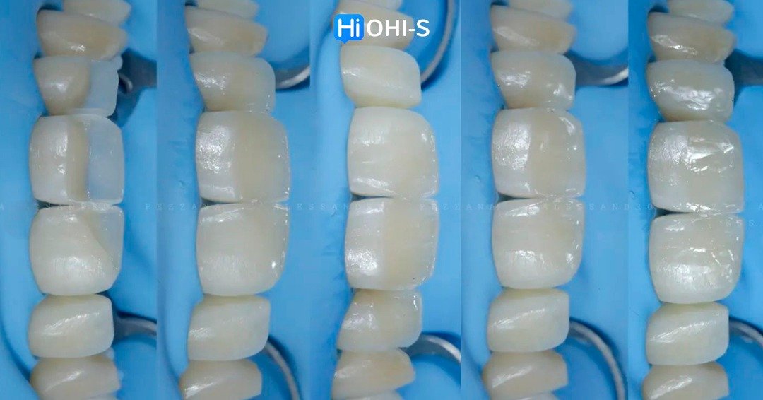 International schools working with composite restorations 6.jpg