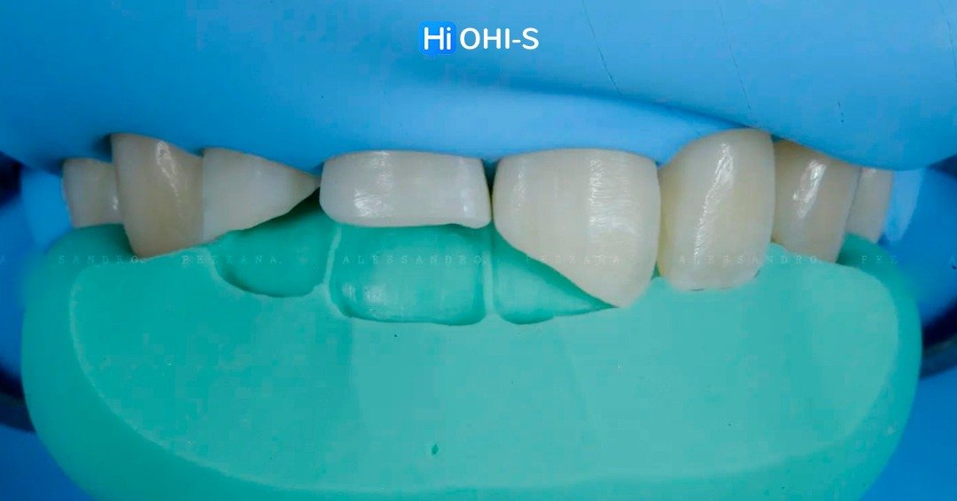 International schools working with composite restorations 4.jpg
