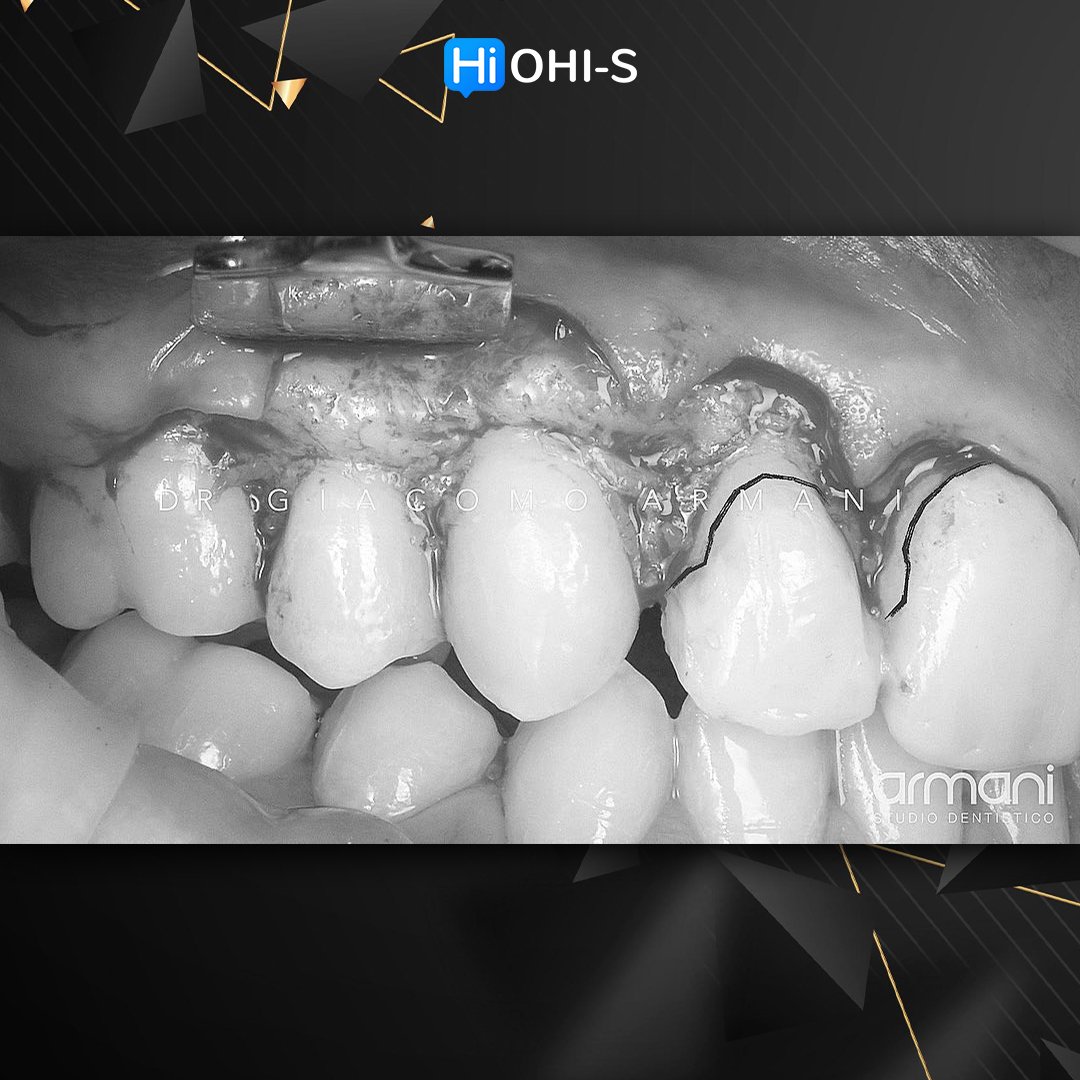 Ceramic Veneers Interdisciplinary Approach and Updated Protocols 4.jpg
