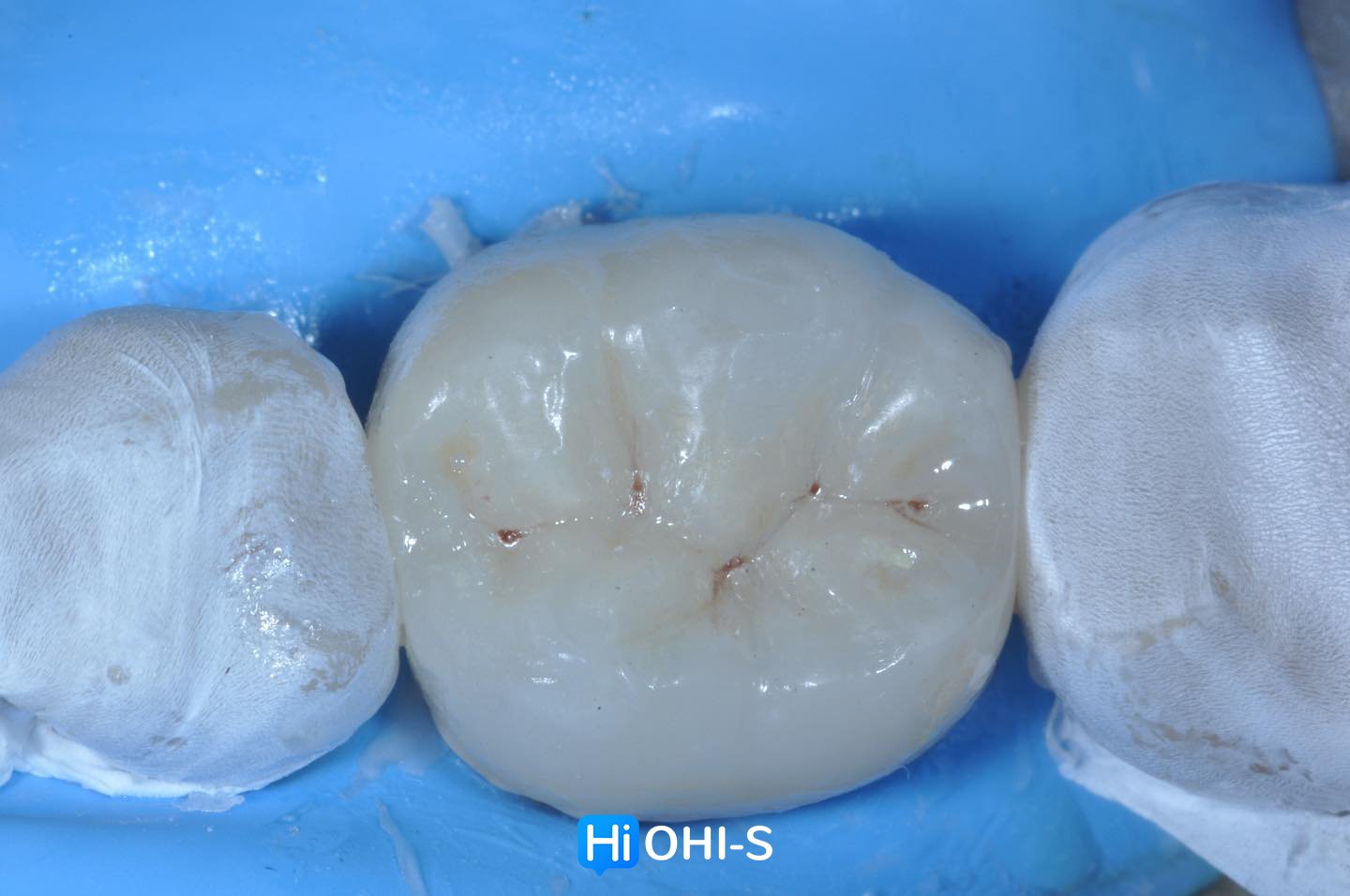 Ceramic Restorations Veneers, Inlays, Crowns 7.jpg