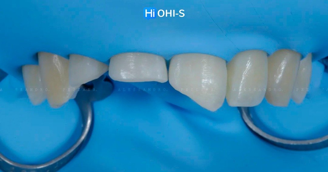 International schools working with composite restorations 2.jpg