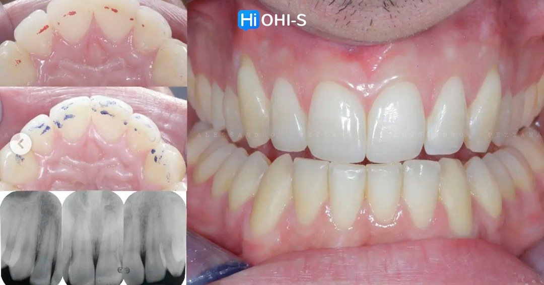 International schools working with composite restorations 8.jpg