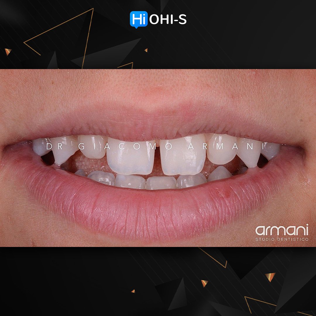 Ceramic Veneers Interdisciplinary Approach and Updated Protocols 2.jpg