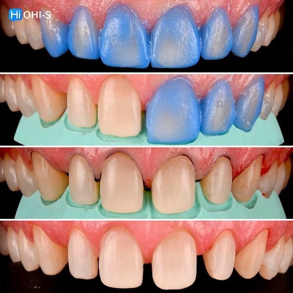 Ceramic Veneers Interdisciplinary Approach and Updated Protocols 5.jpg