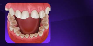 Worn dentition treatment 2 updated and new protocols.jpeg