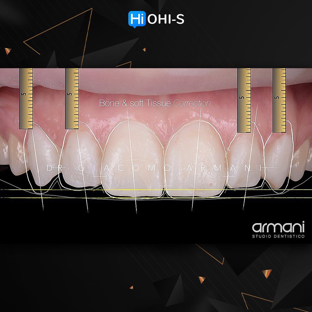 Ceramic Veneers Interdisciplinary Approach and Updated Protocols 3.jpg