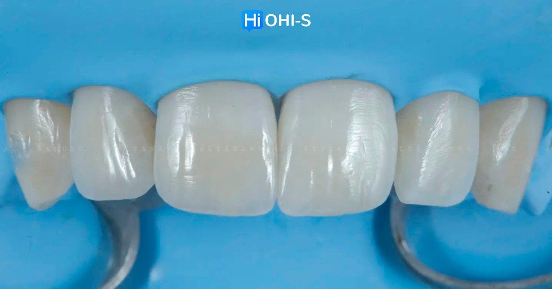 International schools working with composite restorations 7.jpg