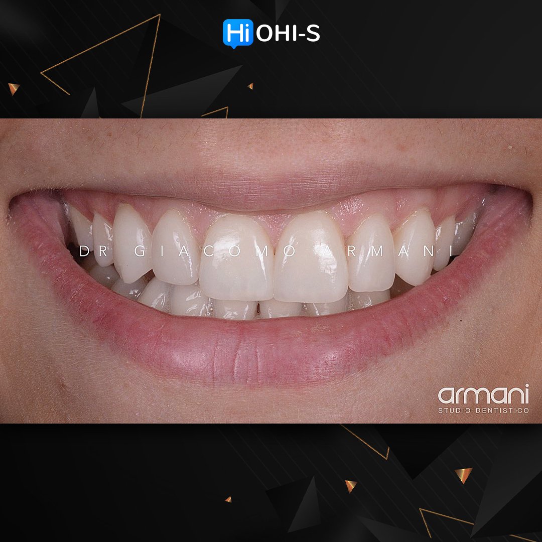 Ceramic Veneers Interdisciplinary Approach and Updated Protocols 1.jpg