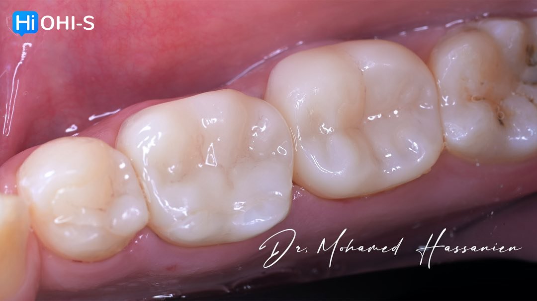 Complete Prosthetic Protocols CAD CAM CEREC 2.jpg