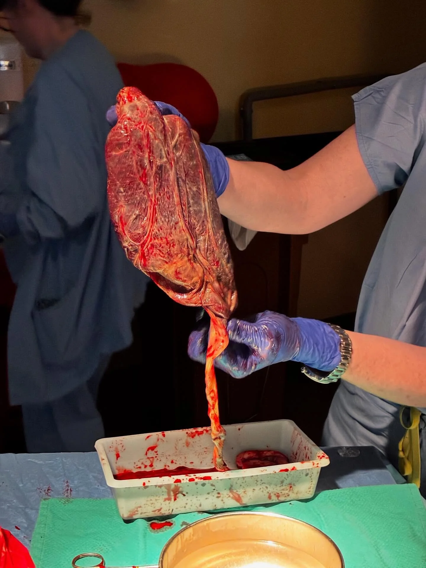 I love a placenta tour and I encourage all of my clients to ask for one. This placenta had a velamentous cord insertion, meaning the cord inserts into the membranes surrounding the baby rather than the placenta, leaving vessels exposed without protec