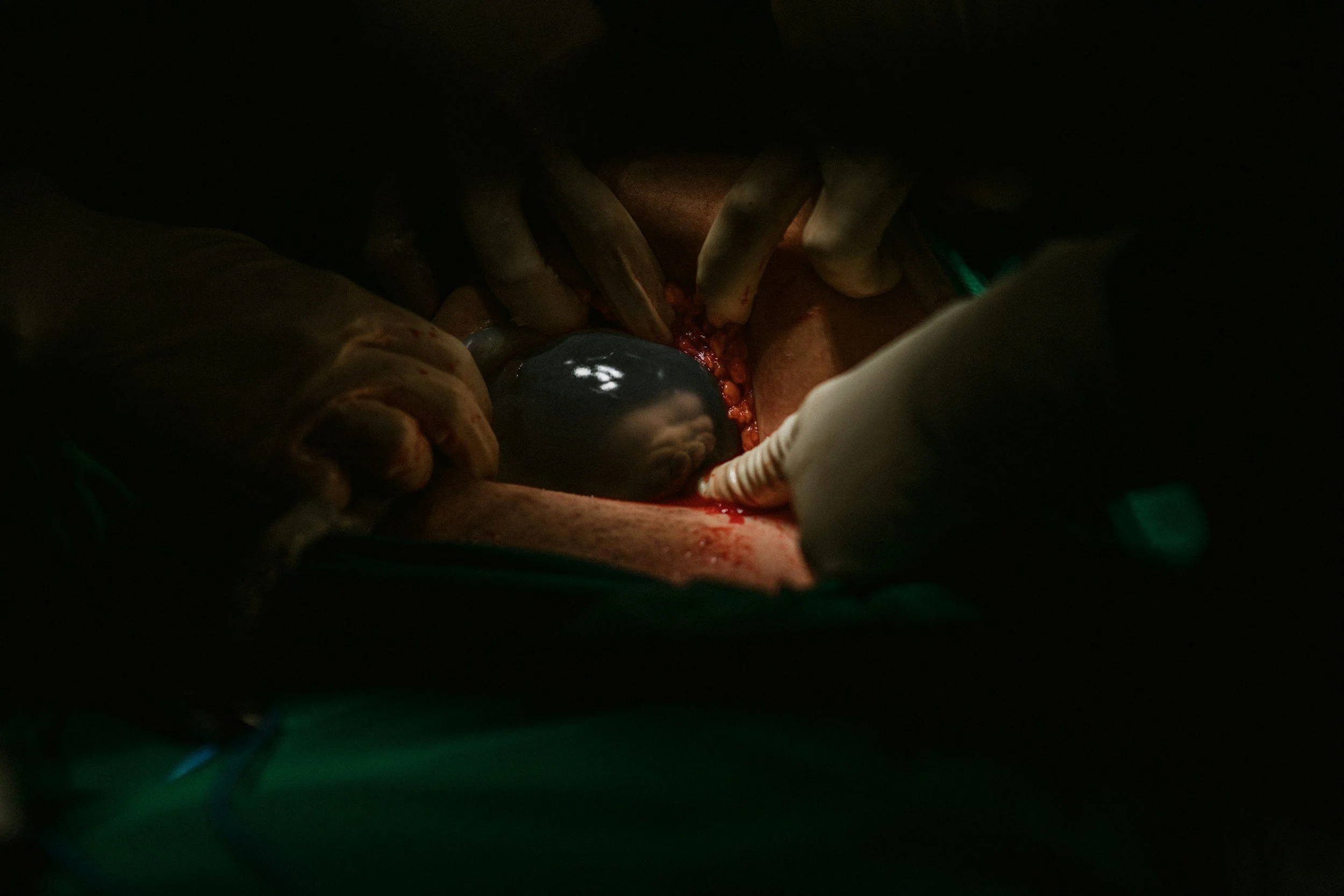 Entering the Third Trimester: Prep for Cesarean Birth