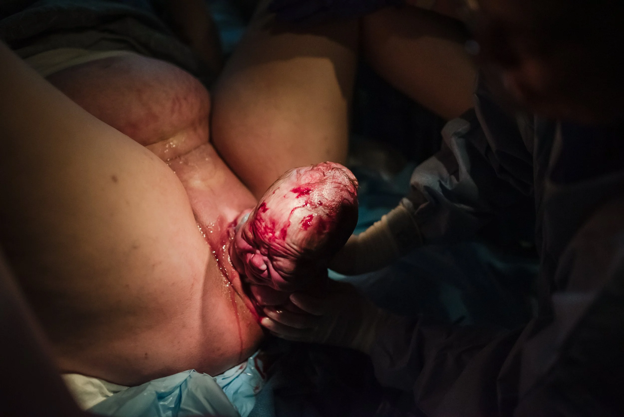 A person giving birth in a medical setting, with medical staff assisting during labor.