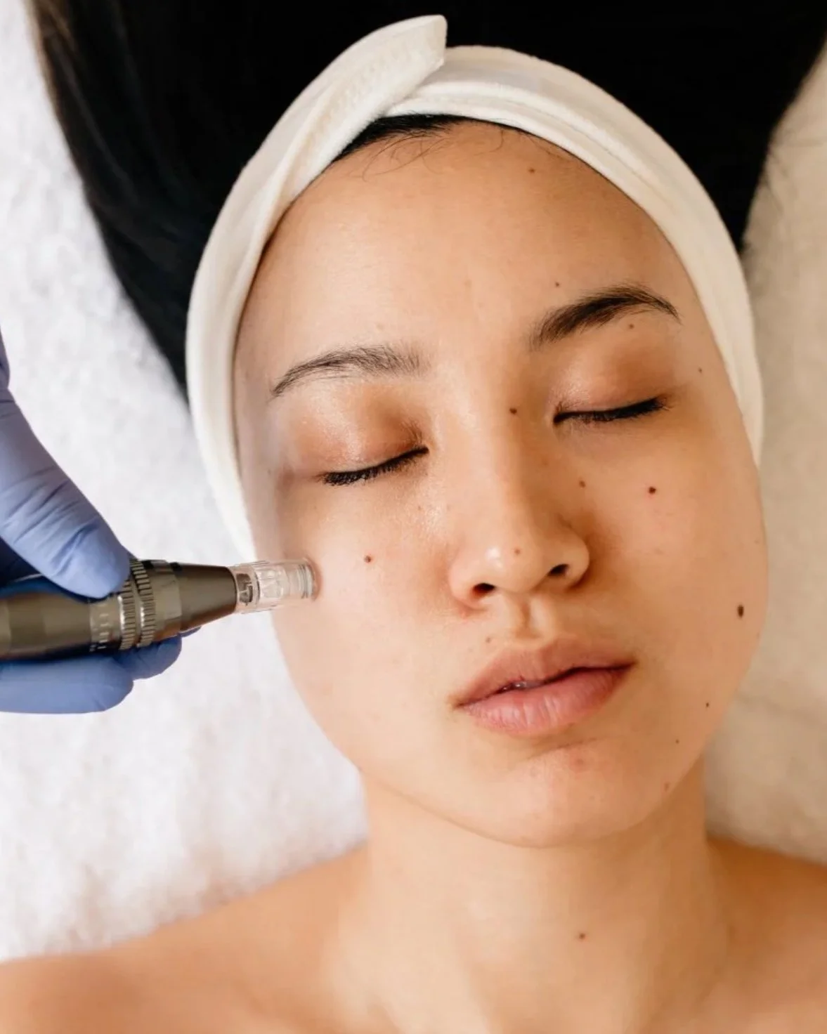 Person receiving a microneedling treatment with PDRN