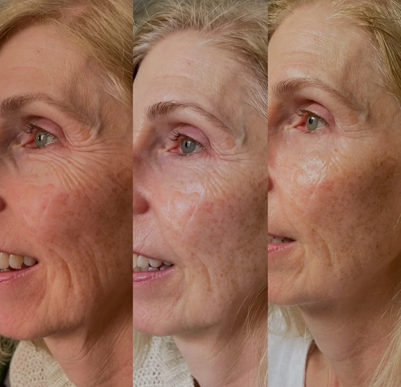 Side-by-side comparison of a woman's face showing the improvement of fine lines and wrinkles with this anti aging facial treatment