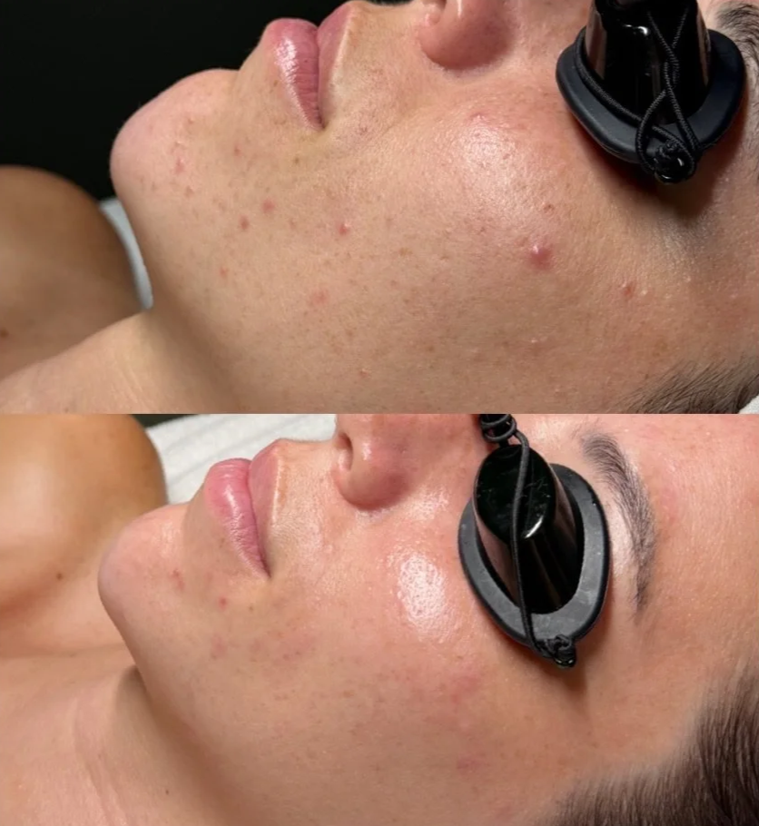 Relaxed person receiving a facial spa treatment with facial massage and lymphatic drainage