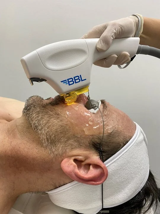BBL Hero: Advanced IPL for Clearer, Younger & Healthier Skin