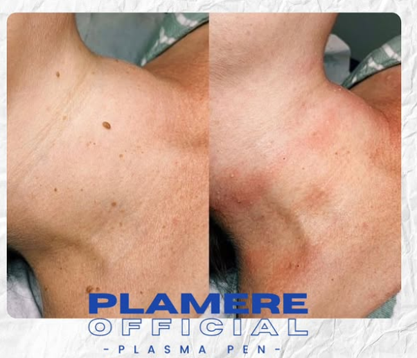Before and after example of suitable neck skin tags treated with Plamere plasma technology