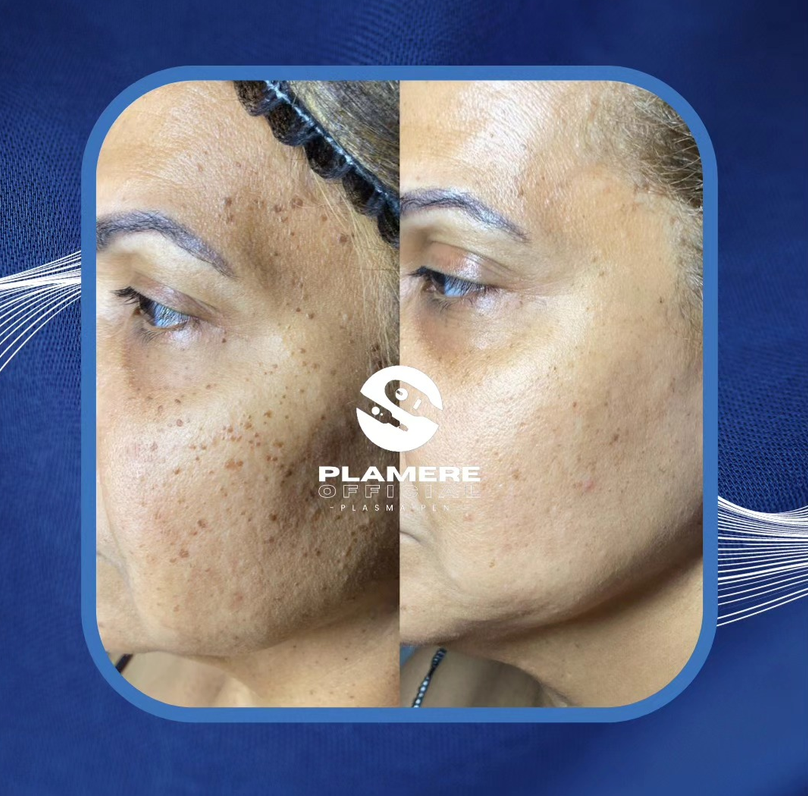 DPN Plasma Pigment Removal before and after