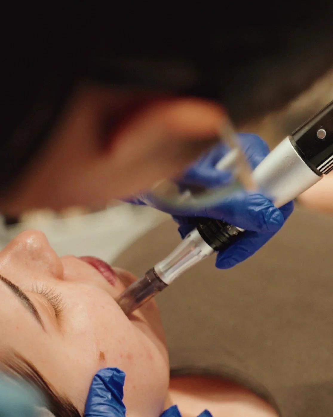 1NEED Pro microneedling treatment at Ashby Beauty Bar near Maclean NSW