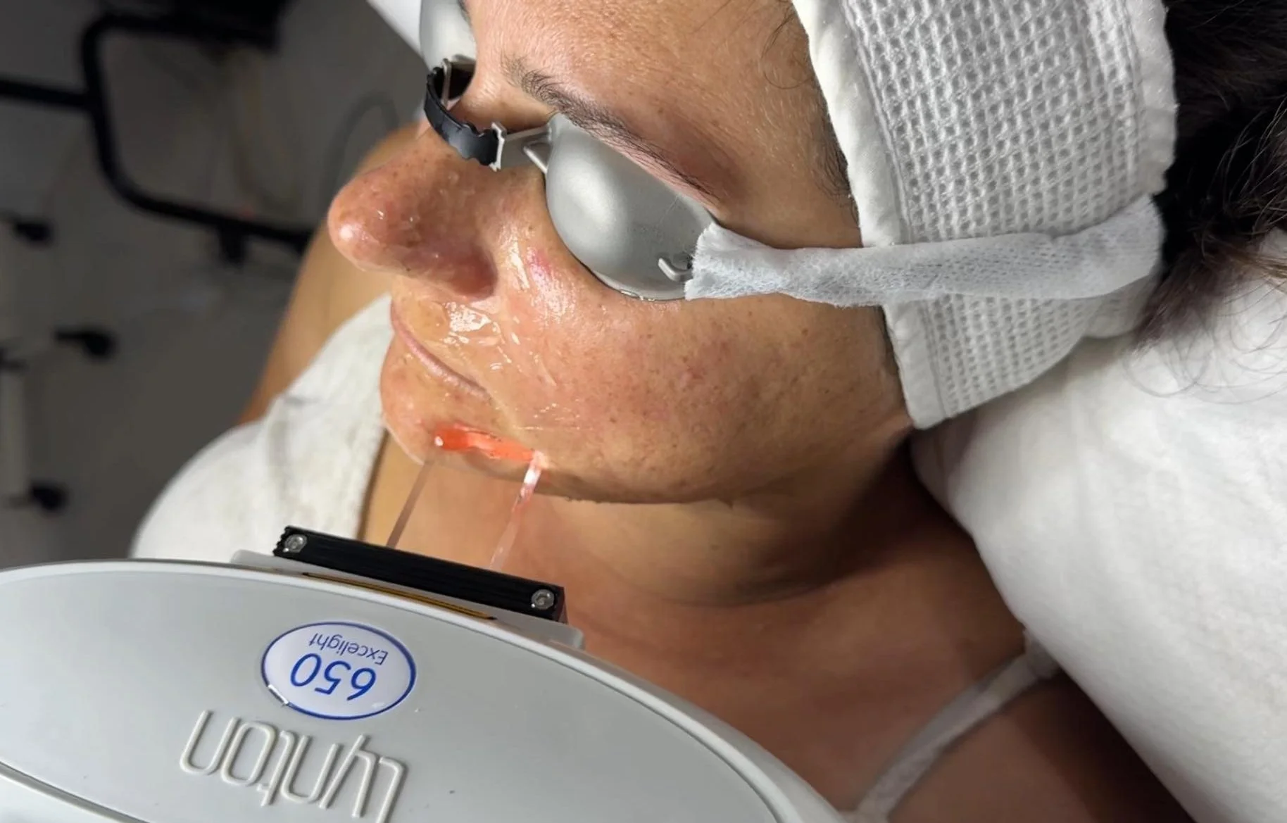 A woman lying down at Ashby Beauty Bar receiving a Lynton IPL facial treatment.