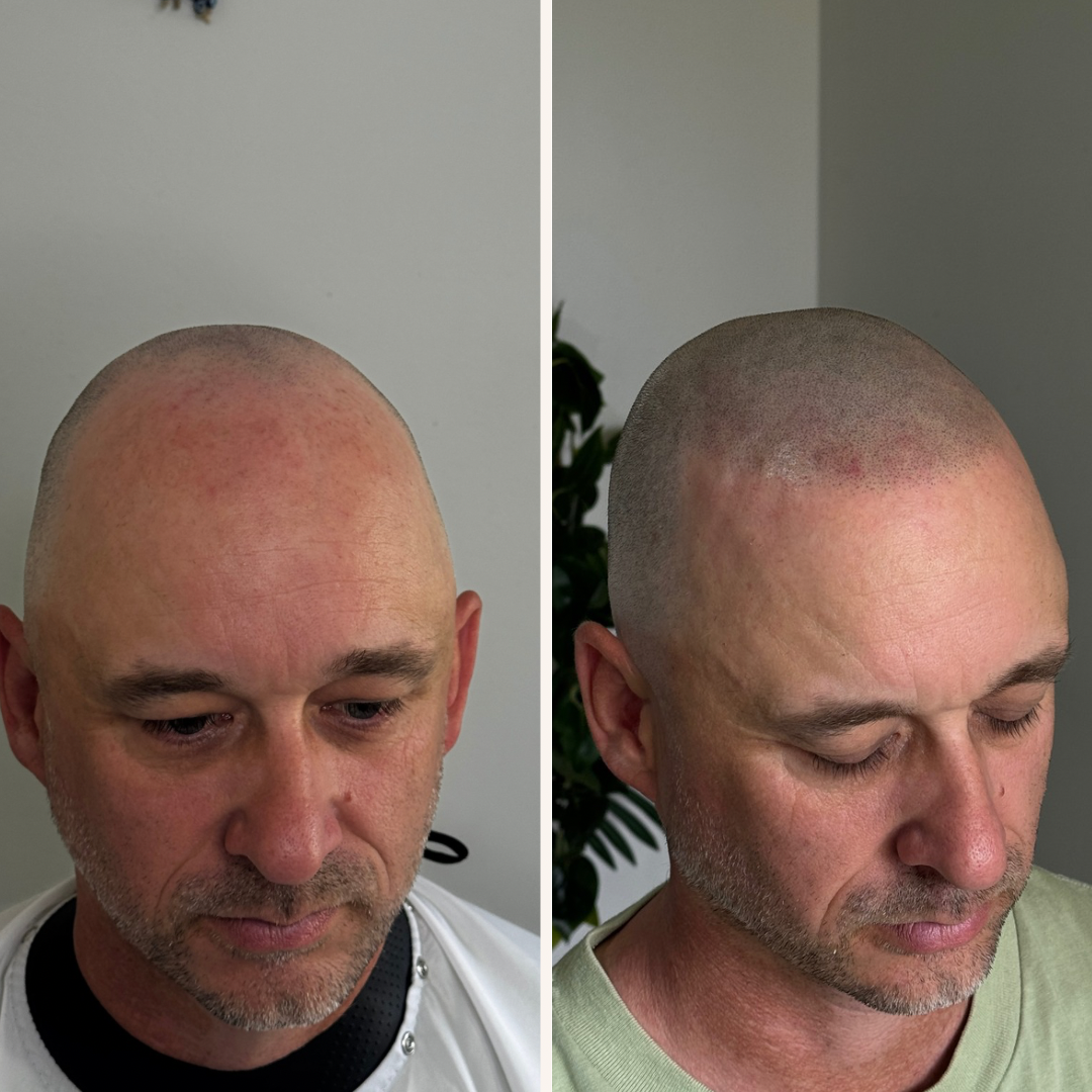 Side-by-side before and after photos of a man with shaved head, showing the scalp after having scalp micro pigmentation done.