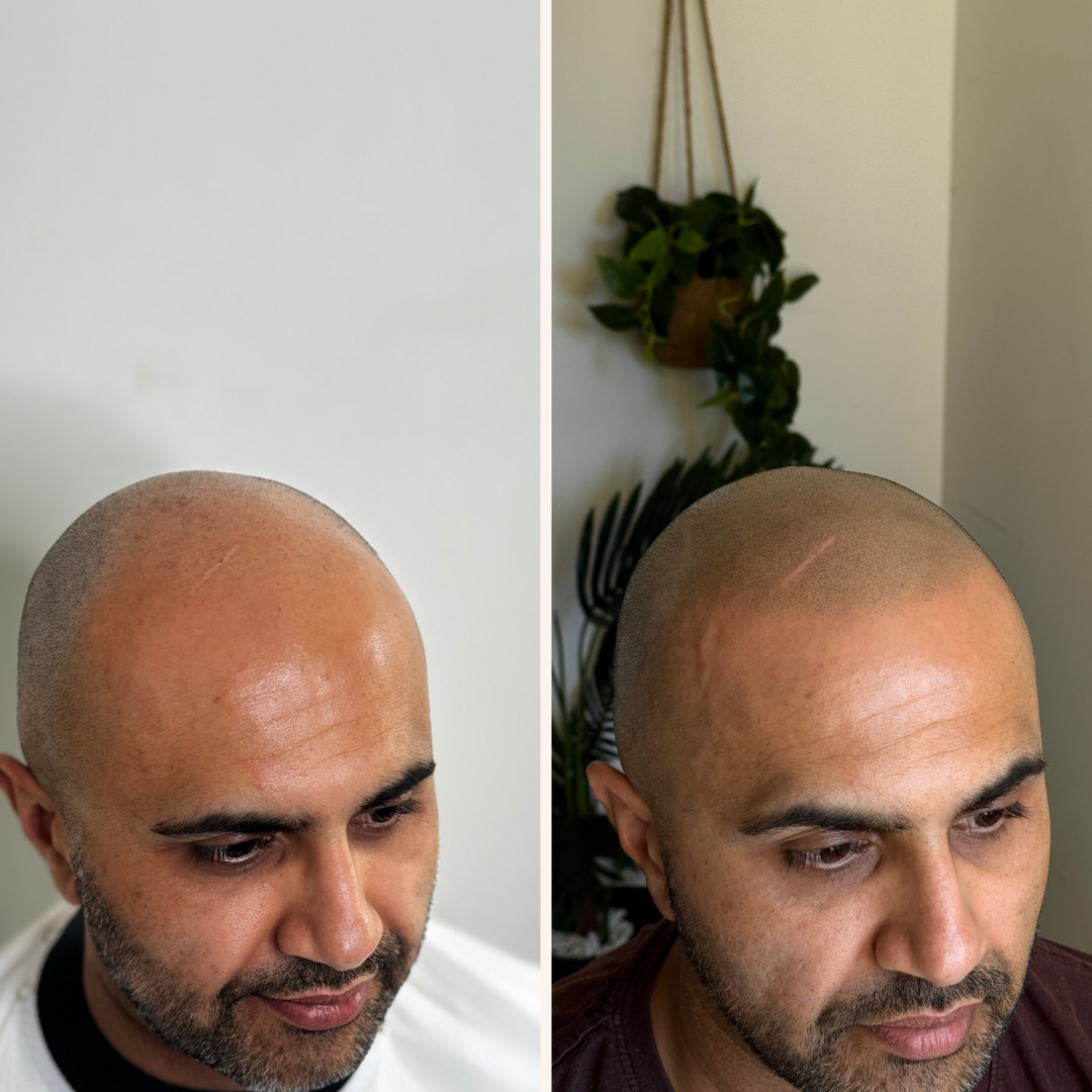 Comparison of a man's scalp before and after hair restoration treatment, showing a shaved head with some hair loss on the left and improved hair density on the right.