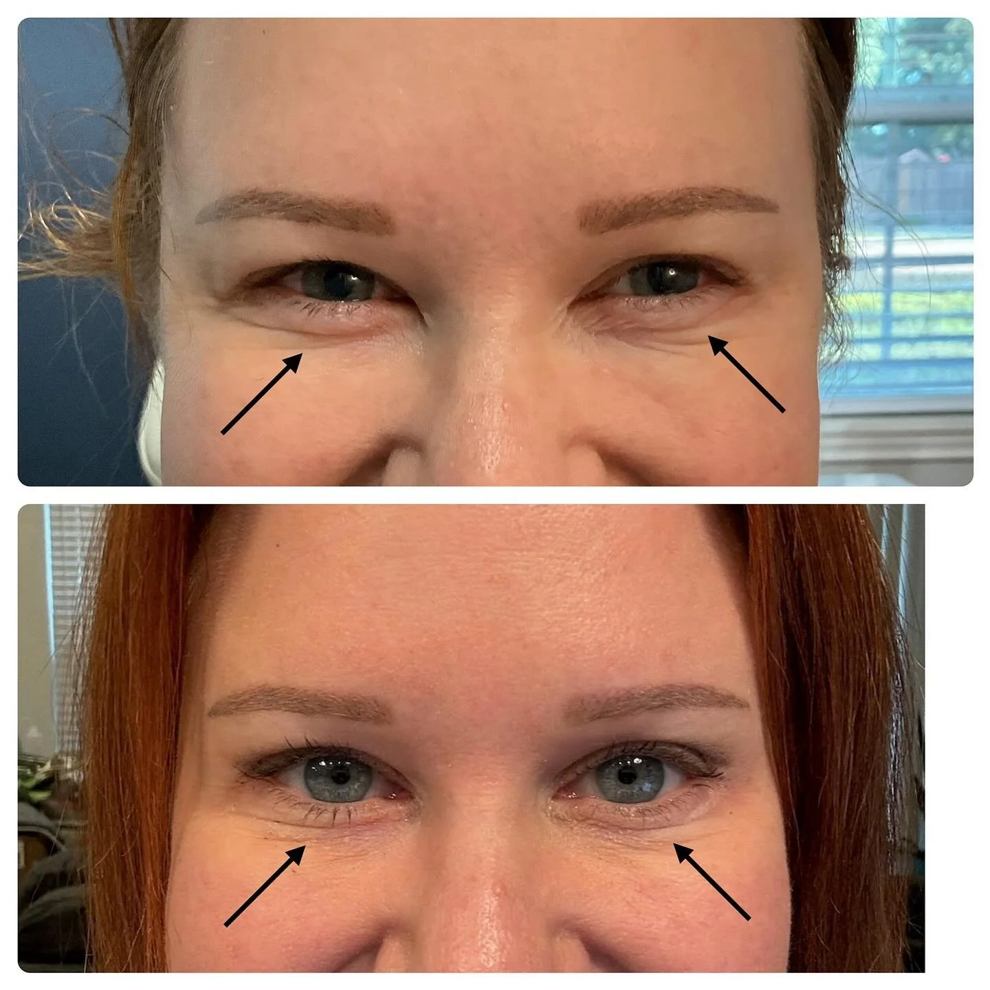 Here is an example of a way that we can use Botox (or Dysport or Xeomin) that you may not know about! 

&ldquo;Jelly roll&rdquo; is a term that describes the bulging under eyes that can create a puffy or rolled effect. This bulge is caused by contrac