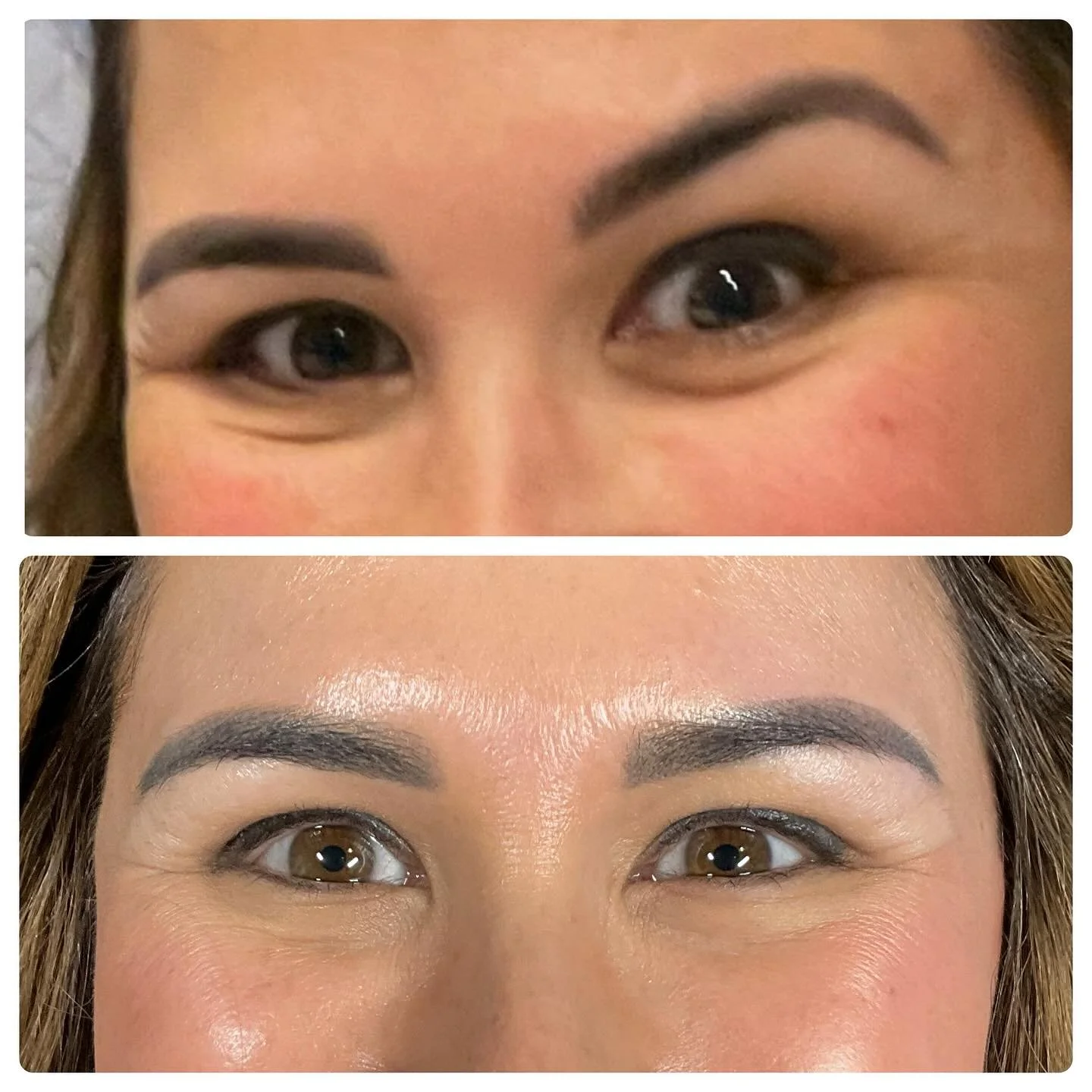 Before and after Botox for &ldquo;jelly roll&rdquo;. This beautiful girl was not new to Botox, but she had no clue that it could fix her under eye bulging. So good 🤩. If you&rsquo;re on the fence come see me! Let&rsquo;s talk about your goals. I&rsq