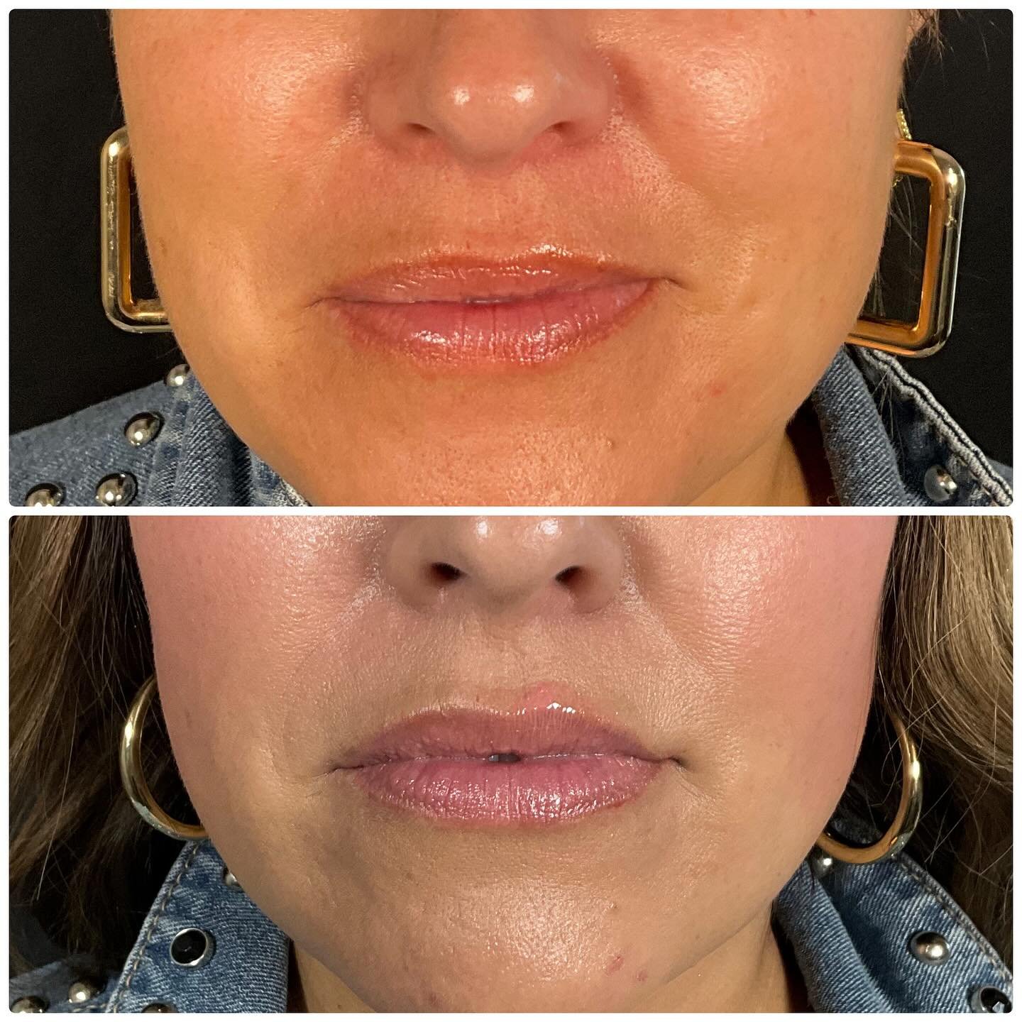 ✨ **Lip Flip Magic with Botox. Subtle but impactful**✨ 

With just a few quick injections of Botox, we can create a subtle, more defined upper lip by relaxing the muscles around your mouth, giving you a fuller, natural-looking pout.

🔹 **Cost**: $50