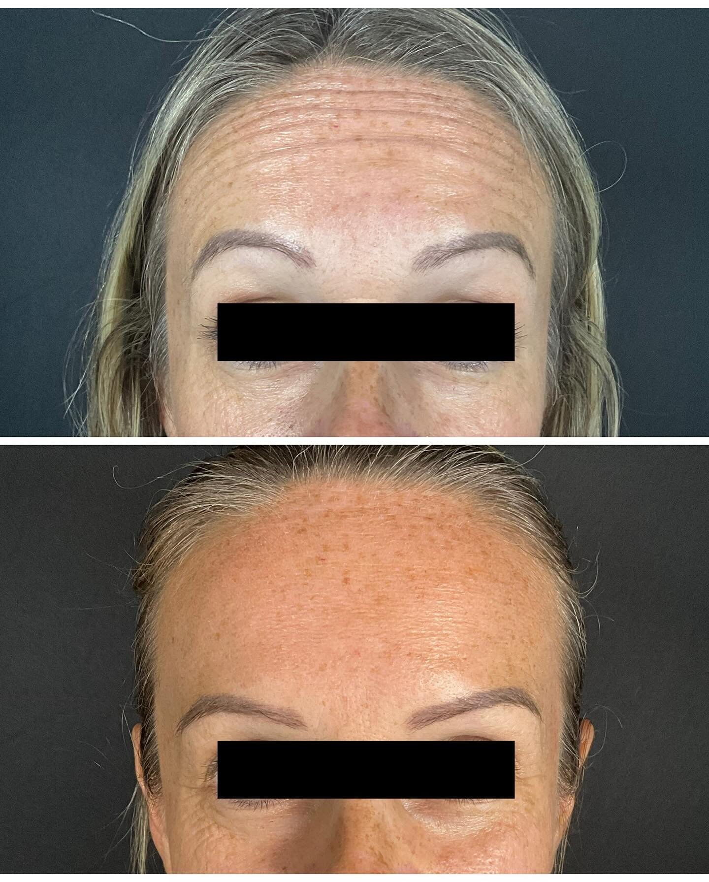 Relaxing dynamic wrinkles all over the #hillcountry. Perfectly smooth and beautifully natural. 

Product: Dysport
Total used: 55 units
Downtime: minimal - go back to your normal activities after 24 hours 
Cost: $200-$500 depending on amount of produc