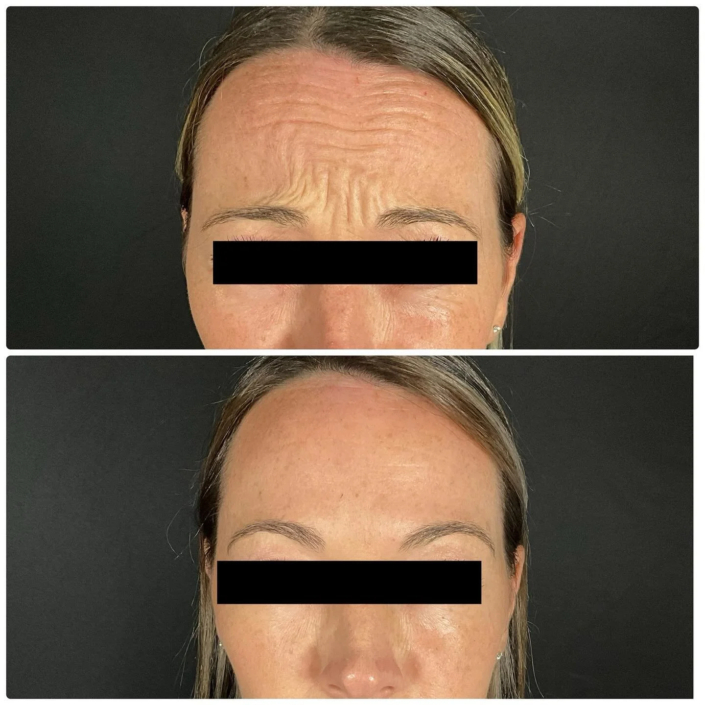 Smooth and Confident with Xeomin 🤩

Fall is the perfect time to refresh your look with Xeomin&mdash;a natural, purified option to smooth out those unwanted fine lines and wrinkles. 🍂

Here&rsquo;s why now is the best time for Xeomin:

💧 Cooler Wea