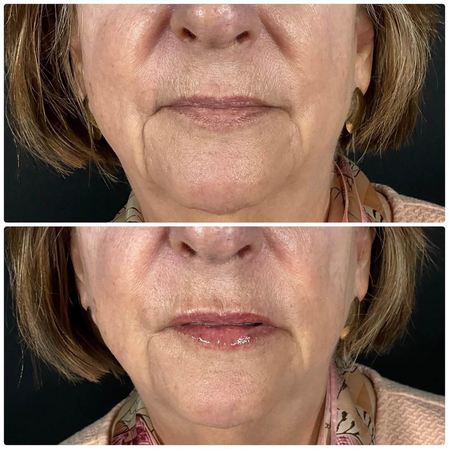 Lip filler for mature lips. 

Our goal here was to add subtle hydration and soften the &ldquo;smokers lines&rdquo; above her top lip. We also did a little Botox in that area otherwise known as a &ldquo;lip flip&rdquo; that will improve those lines ev