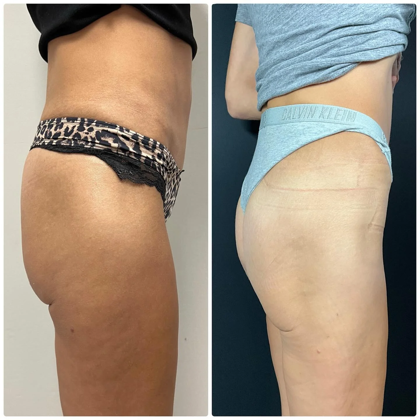 Before and after nonsurgical BBL 🍑

These photos were taken 6 months apart, after just ONE non-surgical Sculptra BBL session. You can already see the natural lift and enhancement&hellip;AND we&rsquo;re not done yet&mdash;we plan to do one more treat