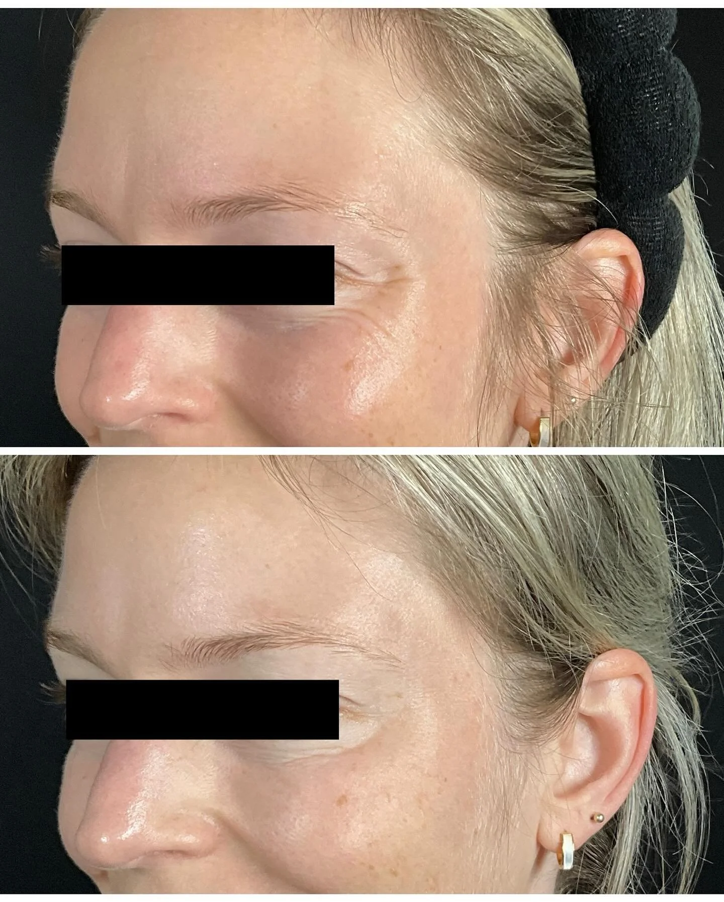 Botox before and after. Never gets old 🤩

THIS MONTH BOTOX IS ONLY $11/unit! Get it before it&rsquo;s gone 💉

#botox #drippingsprings #atx #austin #nursepractitioner #zoskinhealth