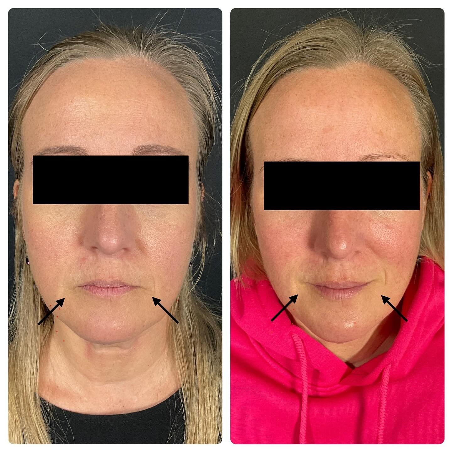 From RBF to Resting Bliss Face! Did you know that the classic RBF isn&rsquo;t just a mood? It&rsquo;s caused by your DAO muscle which is responsible for pulling the corners of your mouth downward&hellip;EVEN when we are happy!
 
With a few units of D